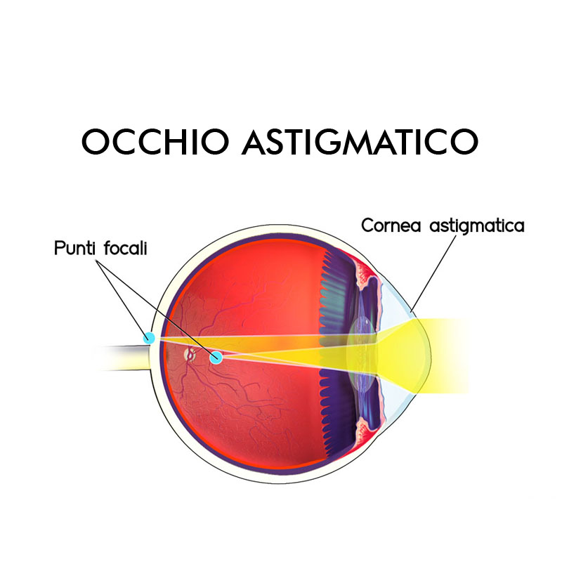 Infografica astigmatismo difetti visivi Vista Vision