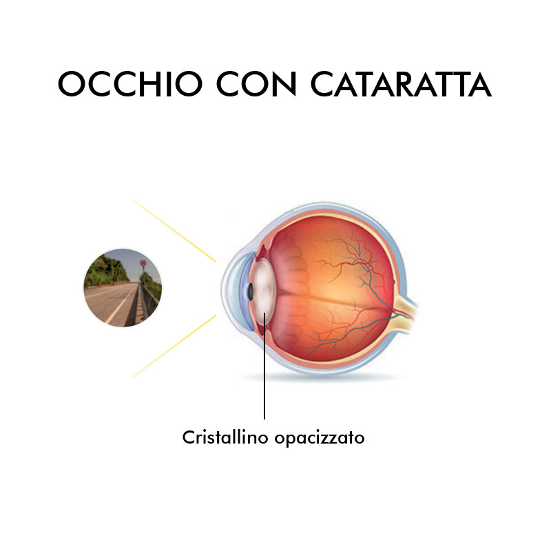 info grafica cataratta Vista Vision