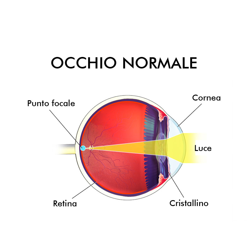 Infografica presbiopia difetti visivi Vista Vision