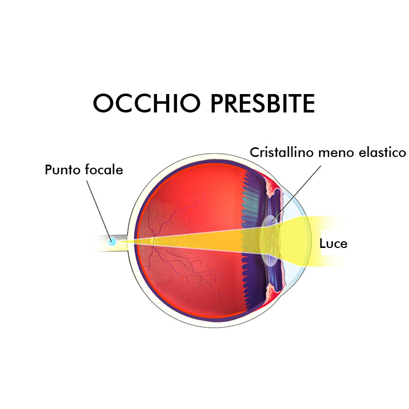 Infografica presbiopia difetti visivi Vista Vision