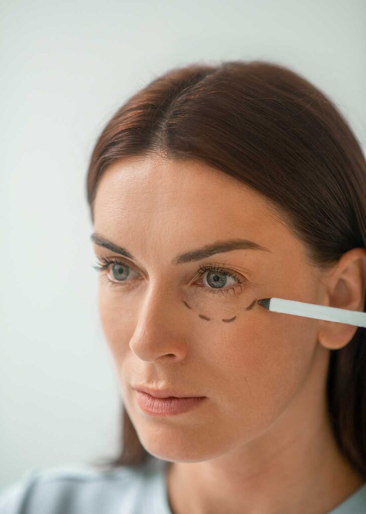 donna che sta per fare una blefaroplastica per inestetismo palpebrale