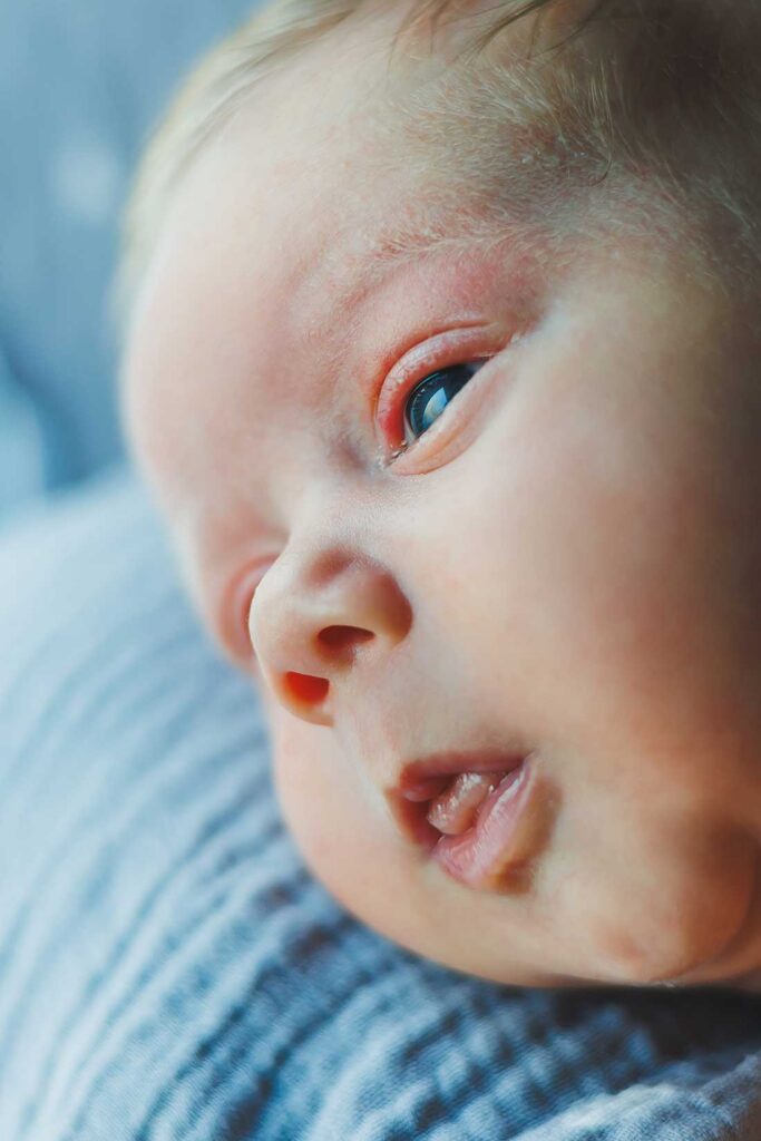 neonato con sintomi da ostruzione delle vie lacrimali