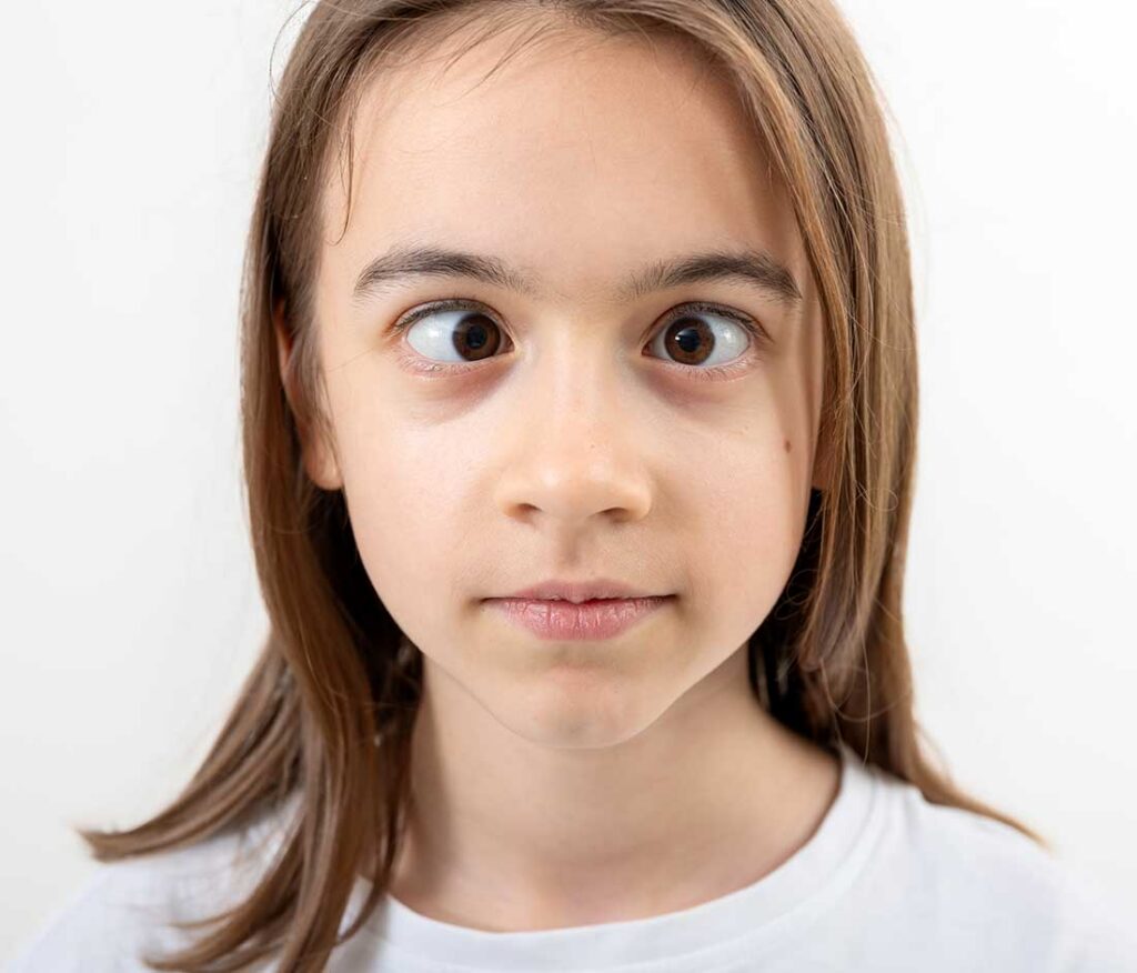 bambina con strabismo sintomo di ambliopia
